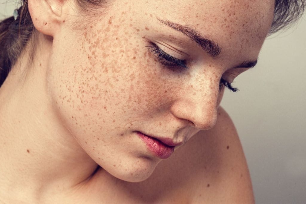 freckle removal treatments